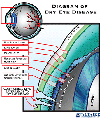 Diagram of Dry Eye Disease